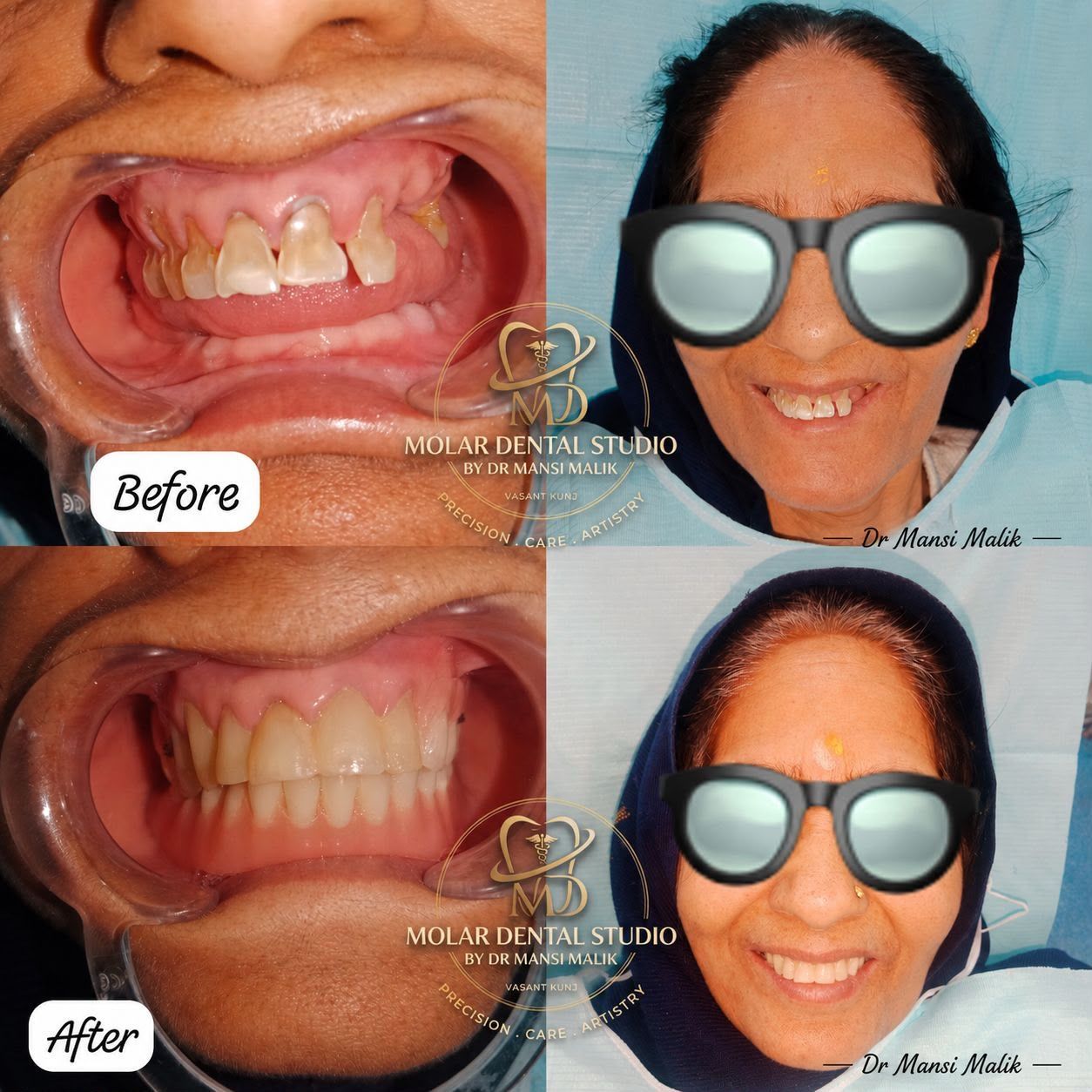 Before and after photographs of broken upper front teeth restored with a fixed prosthesis
