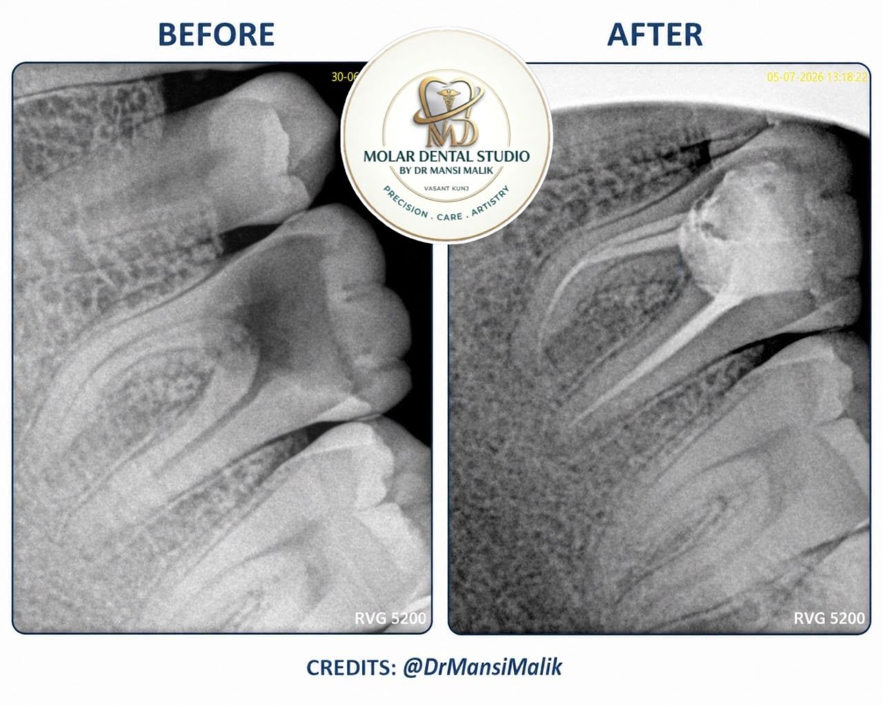 Before and after RVG dental radiographs of a root canal treatment showing the filled canals