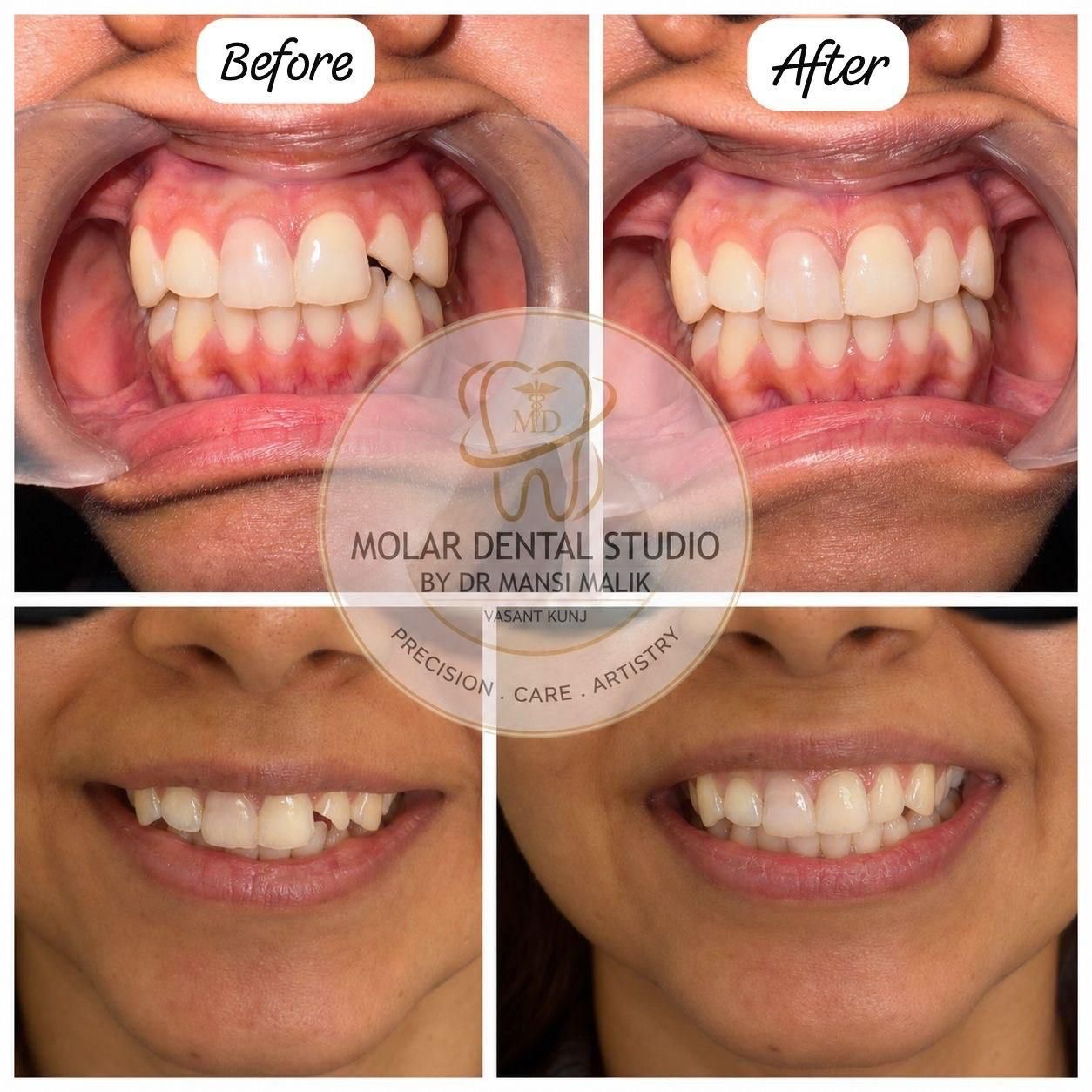Before and after photographs of an alignment case, with the smile line evened out